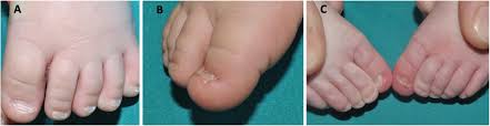 Image result for Koilonychia feet