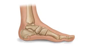 A common cause of bone spurs is osteoarthritis. What Are Heel Spurs Learn Symptoms Causes And Treatment
