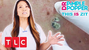 I am addicted to dr. This Is Zit Ein Riesiger Mitesser Dr Pimple Popper Tlc Deutschland Youtube