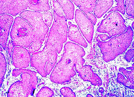 Report of 3 cases and review of the literature. Hpv Esophagus Pathology Outlines Carcinogenicity