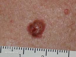 Some types of skin cancer are more dangerous than others, but if you have a spot. Can You Spot Which Moles Are Deadly The Skin Cancer Signs You Need To Know