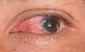 Symptoms of a scratched eye the cornea is one of the most sensitive parts of your body. How To Get Rid Of Red Eyes Top 5 Causes