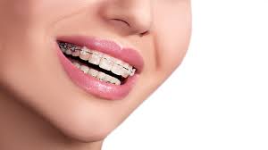 However, it won't cover everything, which means you will have to pay at least part of. How Much Do Braces Cost In Canada Empress Walk Dental