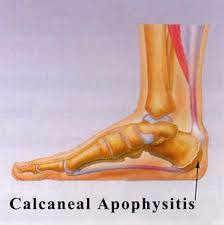Image result for Calcaneal Apophysitis