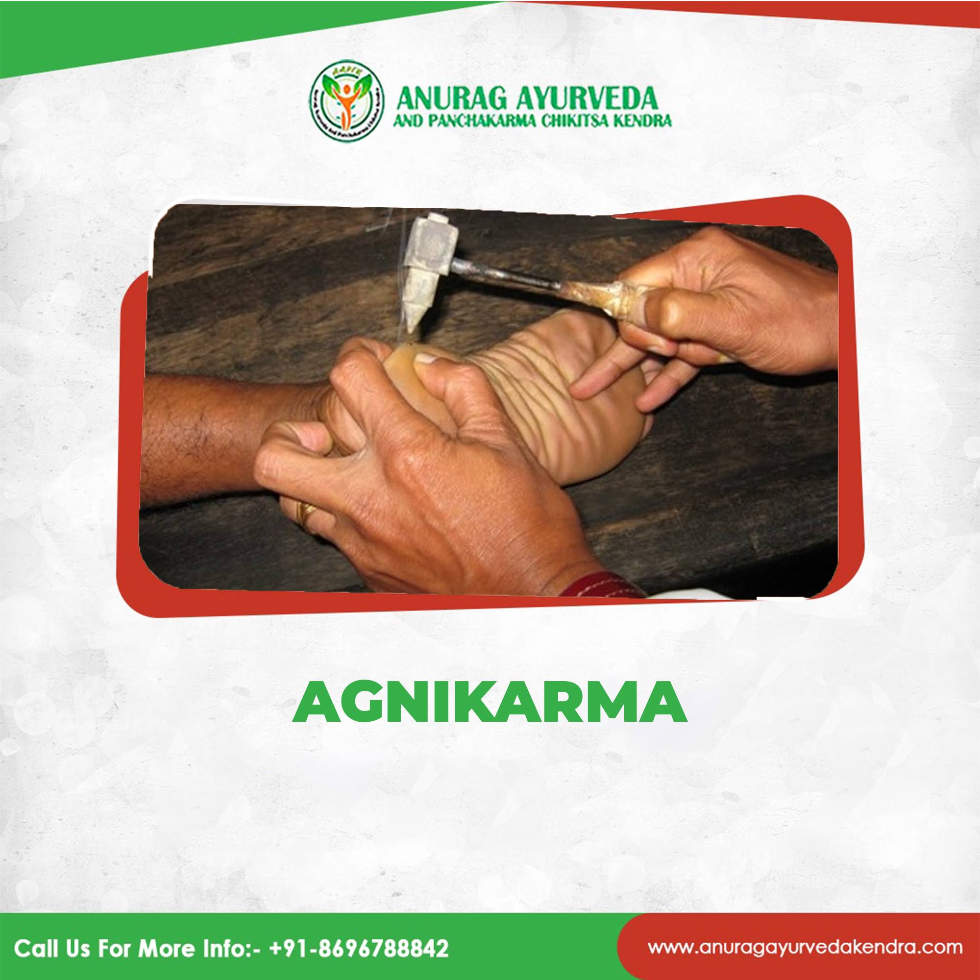 Agnikarma product image