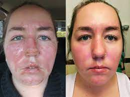 Please share this article with your friends and family. Woman Photos Show The Healing Process Of Second Degree Burns