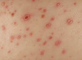 Image result for Varicella zoster on human skin