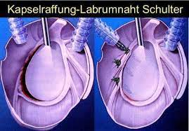 Schulterluxation Und Schulterinstabilitat Auskugeln Und Einrenken Der Schulter Gelenk Klinik De