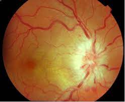 Ocular Manifestations Of Lyme Borreliosis In Europe