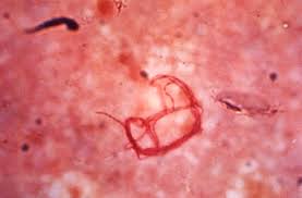 Image result for chancroid