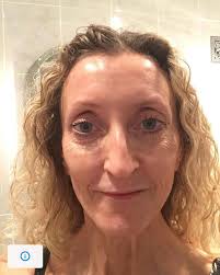 Woman gets sun damage and wrinkles