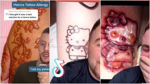 I have daviobet for my psoriasis, will this i am having an allergic reaction to red ink in a tattoo i recently got. Henna Allergic Reaction Tiktok Compilation Unnatural Henna For The First Time Youtube