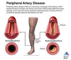 Peripheral Artery Disease The Mount Sinai Hospital Peripheral Artery Disease Arteries Coronary Artery Disease