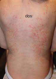 From may to september, an evening menu including local specialties is also proposed upon reservation. Dermato Info Eruption Polymorphe De La Grossesse