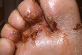 Image result for pompholyx soles of feet