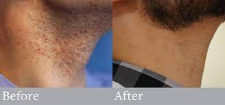 Some men want to leave a goatee, or perhaps just a mustache, while others prefer to have all the beard and mustache. Ditch The Neck Hair Laser Hair Removal For Men Plastic Surgery Associates