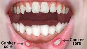 Canker Sore How To Get Rid Of Canker Sores Of The Lips And Throat Dentist In Santa Rosa