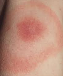 And body aches, occasionally with a skin rash and swollen lymph glands. Skin Rash In Meningitis And Meningoencephalitis Neurology