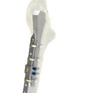 Ortholox® Locking Periprosthetic Support Cable-Plate Systems