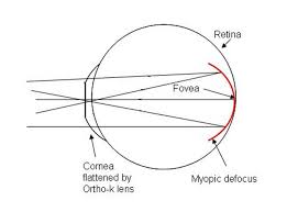Https Theeyeclinic Com Sg Images Atropine 0 01 Png How Does Ortho K Control Myopia The Retina Light Rays To Focus