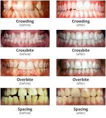 Orthodontics In Lexington Ky - Brewer Family Dental