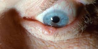 The uvea is the middle layer of the eye and has 3 parts: What Is Mohs Surgery American Academy Of Ophthalmology