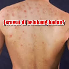 Sebagian besar benjolan di leher belakang tidak berbahaya dan dapat sembuh atau hilang dengan sendirinya. Sihat Ceria Bergaya Masalah Jerawat Di Belakang Badan
