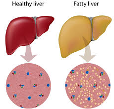 Fatty Liver What It Is And How To Get Rid Of It