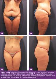 The amount of excess skin that you'll be left with following a gastric sleeve operation varies from patient to patient. Limited Incision Bodylift From Head To Toe For The Massive Weight Loss Patient Bariatric Times