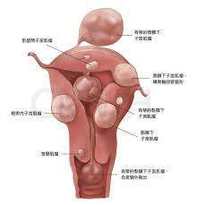 子宮肌瘤| 中亞健康網- 用心傳遞每一刻為您把關健康人生