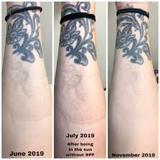 Very dark, or large professional tattoos, will remain tender and swollen for a few days.there may be some lightening or darkening of the skin for several months after laser treatment. Figured I D Post An Update And A Reminder To Stay Out Of The Sun I Had A Bit Of A Setback In July From Being Outside Without Sunscreen But It Has Continued