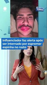 Influenciador faz alerta após ser internado por espremer espinha no rosto #BalançoGeral #Shorts