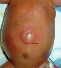 Image result for Necrotizing Enterocolitis