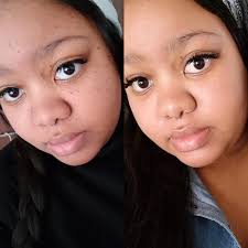 What Are These Little Black Moles On My Face little black moles on my face