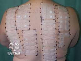 Image result for Patch Testing