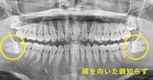 口腔外科・親知らず｜船橋、船橋駅近くの歯医者｜船橋 森谷歯科クリニック さん