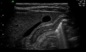 Hifu ultrasound ultrasound sincoheren germany 4d 5d hifu machine 8 cartridges top sales 8 shot 11 lines 3d 4d hifu usa importe focused chip ultrasound hifu. Congenital Hypertrophic Pyloric Stenosis Radiology Case Radiopaedia Org