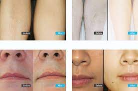 Imagine never having to tweeze, shave, wax! Diode Laser Hair Removal Effect Laser Hair Removal Machine Laser Hair Removal Diode Laser Hair Removal