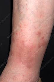 Image result for ant bite