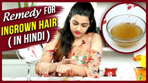Baking soda and oatmeal treatment here's a great combo: Ingrown Hair Removal At Home Remedy For Ingrown Hair In Hindi Diy Ingrown Hair Treatment Youtube