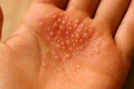 Image result for dyshidrosis