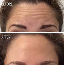 On average, each unit costs about $10 to $15. Botox Injections In Portland Maine Fantastic Results Competitive Pricing