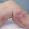 Learn about the symptoms and treatment of this condition. 1