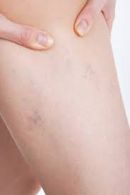 Prevenir Las Varices En La Embarazada