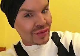 Robin, 34, var besatt av fillers: ”Vad utsatte jag mig för?”