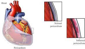 Oct 21, 2020 · pericarditis causes a specific sound, called a pericardial rub. Treating Pericarditis In New Jersey