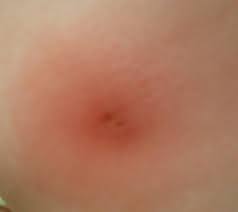 Image result for wolf spider bite skin