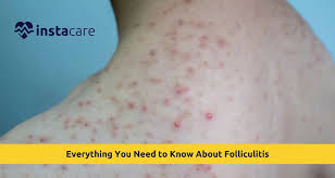 Image result for folliculitis symptoms