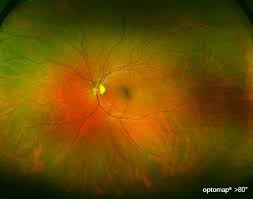 The most frequent cause of an operculated tear is a pvd. Optomap Retinal Scan Orland Park Il Vision Source Orland Park