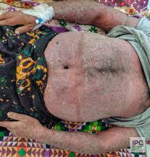 Image result for Pustular Psoriasis